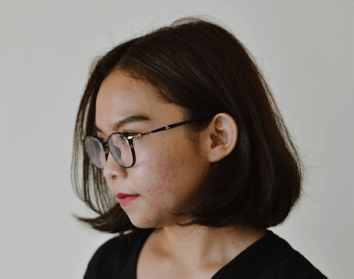 Acne; Menina com acne no rosto